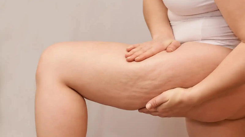 Remedios Naturales para Combatir la Celulitis: Soluciones Efectivas y Saludables - Mar Amoli