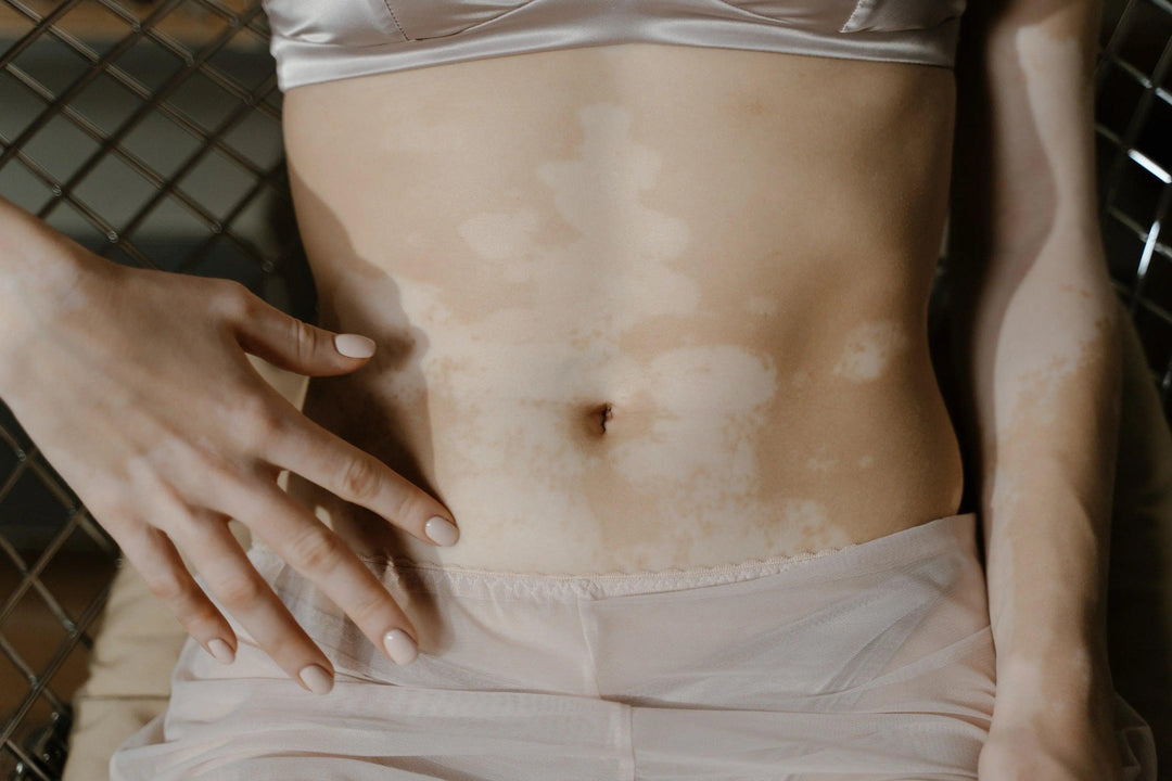 Piel con Vitiligo: ¿Qué Es, Cómo Tratarla y Consejos para Cuidarla? - Mar Amoli