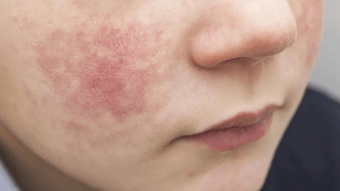 Dermatitis Atópica: Una Guía Integral para el Cuidado de Tu Piel - Mar Amoli