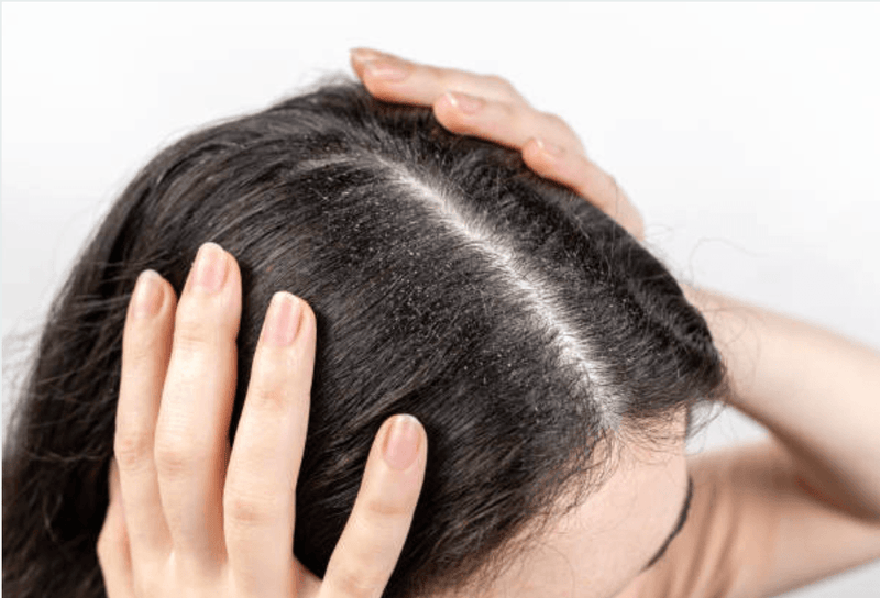 Cómo Prevenir la Caspa y el Frizz en el Cabello: Consejos para Mantener tu Melena Saludable y Manejable - Mar Amoli